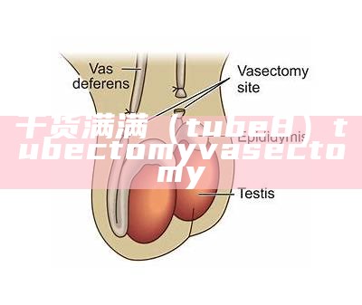 干货满满（tube 8）tubectomy vasectomy